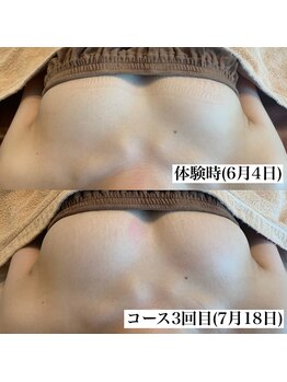 タオ(TAO)/バストアップ症例