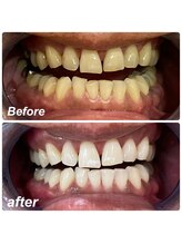 ホワイトベリー 空港通店(White Berry)/ホワイトニング：ビフォアフター