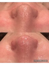 ウォーム(Warm)/40代　毛穴ケア×光フェイシャル