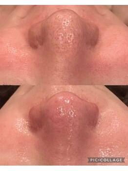 ウォーム(Warm)/40代　毛穴ケア×光フェイシャル