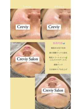 クレヴィー(Creviy)/毛穴洗浄&ハーブ&鼻のwax脱毛
