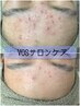【繰り返すニキビのケアに◎】VOSサロンケア/肌管理メニュー初回11000円
