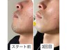 メンズ【脱★青ひげ】髭脱毛(目下～顎下～もみ上げ込) ￥5000→￥3800