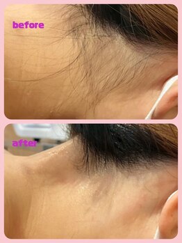 ミレボ(Me.rebo)/うなじ脱毛before→after