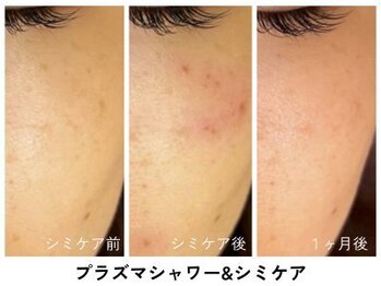 ギルドハナレ(GUILD HANARE)/"シミケア×プラズマ"