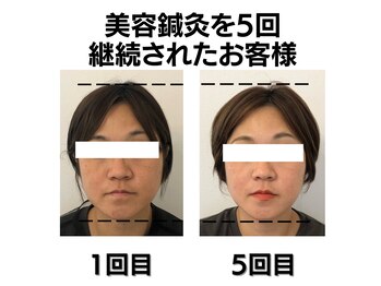 シン(SHINE)/美容鍼灸