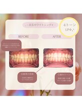 プラスビーセルフ(+b self)/ホワイトニングビフォーアフター