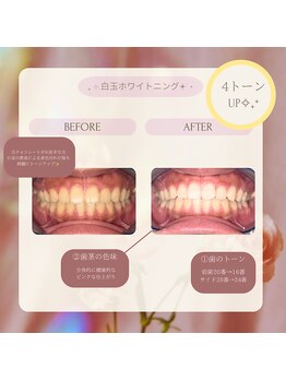 プラスビーセルフ(+b self)/ホワイトニングビフォーアフター