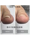 巻き爪改善