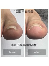 ヴィヴィアンヌ(VIVIANNE)/巻き爪改善