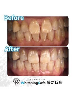 ホワイトニングカフェ 藤が丘店(WhiteningCafe)/ホワイトニングビフォーアフター