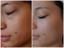 トラット エステアンドアイズ(tratto)/20代　お客様症例写真