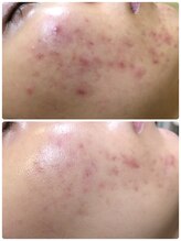 アンジェロ/【ニキビケア】肌育プログラム