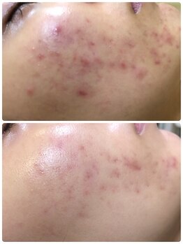 アンジェロ/【ニキビケア】肌育プログラム