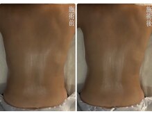 肌音色/■くびれ造形・脂肪燃焼施術例