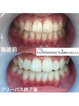 ホワイトニングサロン 京都烏丸店/ホワイトニング施術例