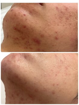 エースマイルイズ(A smile is..)/肌質改善★