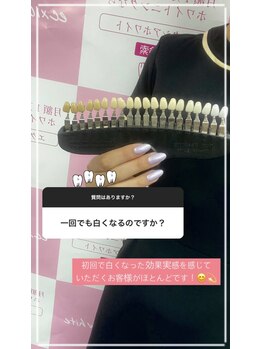 エクシアホワイトニング 徳島店/ホワイトニングストーリー9