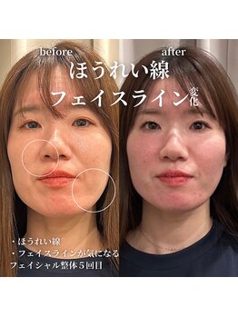 フェアリーフェイス 南森町店(Fairy Face)/南森町/小顔矯正5回目