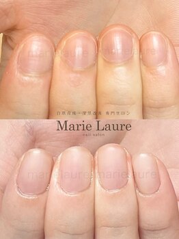 マリーロール 梅田店(Marie Laure)/深爪矯正/自爪育成/自爪風