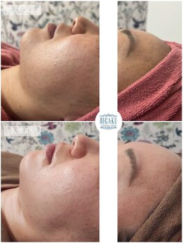 ビガク(BIGAKU)/グリーンピールソフト1DAY