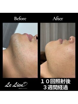 ルリアン(Le Lien)/【メンズ】ヒゲ症例