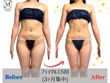 マリス(MARISS)/ブライダル15回コース【痩身】