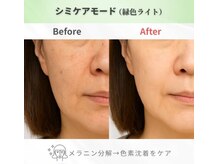 LED×IRの10回の効果!効果がわかりやすい☆高輝度特殊赤外線使用