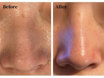 ハーシークレット(Her secret)/ハイドラ毛穴洗浄