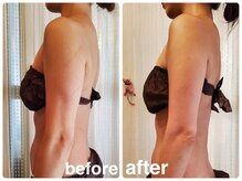 エステサロン キュート(Cute)/Wマシン×ハイパーナイフ上半身