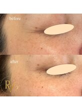 ラヴィス(RAVIS)/プロセル肌質トリートメント 1回