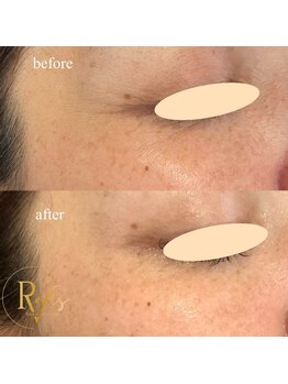 ラヴィス(RAVIS)/プロセル肌質トリートメント 1回