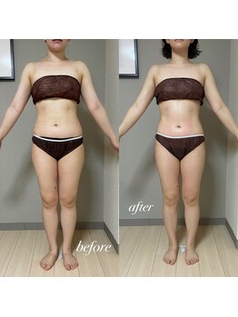 エヌボーテ(N. beaute)/before→after全身コース5回目