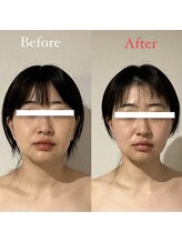 ハイコガオ(HIKOGAO)/小顔矯正60分