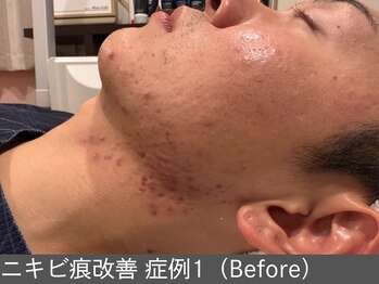 オアシスラグーン(OASIS LAGOON)/ニキビ後の凹凸(症例1 before)