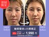 【NEW】輪郭整体！+小顔矯正//鍼が苦手でもOK！頭と顔の歪みを整える