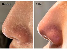 ハーシークレット(Her secret)/ハイドラ毛穴洗浄