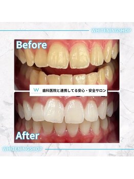 ホワイトニングショップ 甲府店/ホワイトニングの効果
