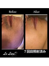 ルリアン(Le Lien)/【メンズ】ヒゲ症例