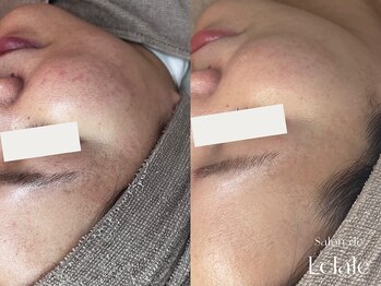 サロンドエクラル(Salon de Eclale wax)/ハーブリプロでみるみる肌質改善