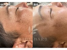 フィズ 戸塚店(FIS)/☆ハーブピーリング☆都度払い