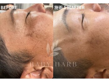 フィズ 戸塚店(FIS)/☆ハーブピーリング☆都度払い