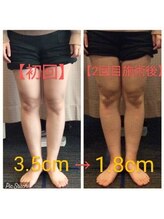 クシロ鍼灸整骨院/【O脚矯正】施術例