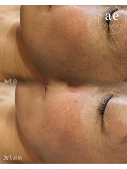 アエ(ae)/ダクトピール