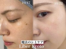 リベルキョウト 京都駅前店(Liber Kyoto)/魔法のシミケア