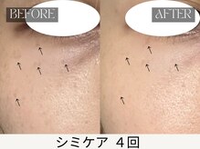 スキンジム(SKIN GYM)/医療レーザー不可の目元も施術◎