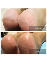 メンズ脱毛サロン レオ(REO)/ビーフォーアフター画像