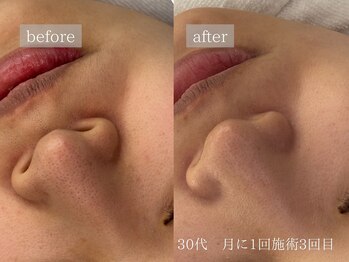 レオン(Leon)/ビフォーアフター