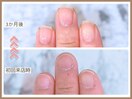 【深爪・チビ爪】でお悩みの方