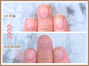 ルシェルアイ/【深爪・チビ爪】でお悩みの方